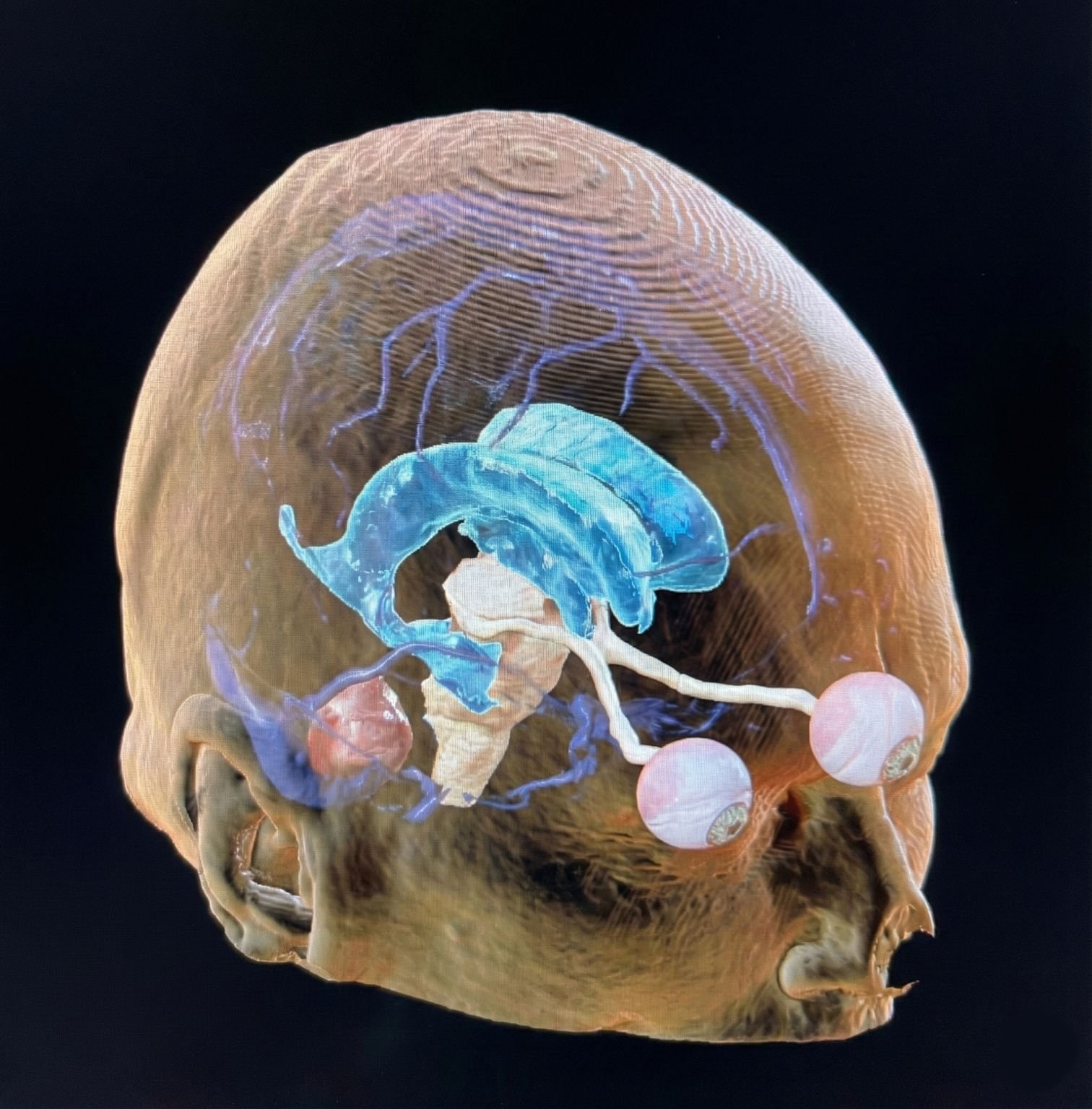 3D reconstruction showing brain vasculature and ventricular system for surgical planning