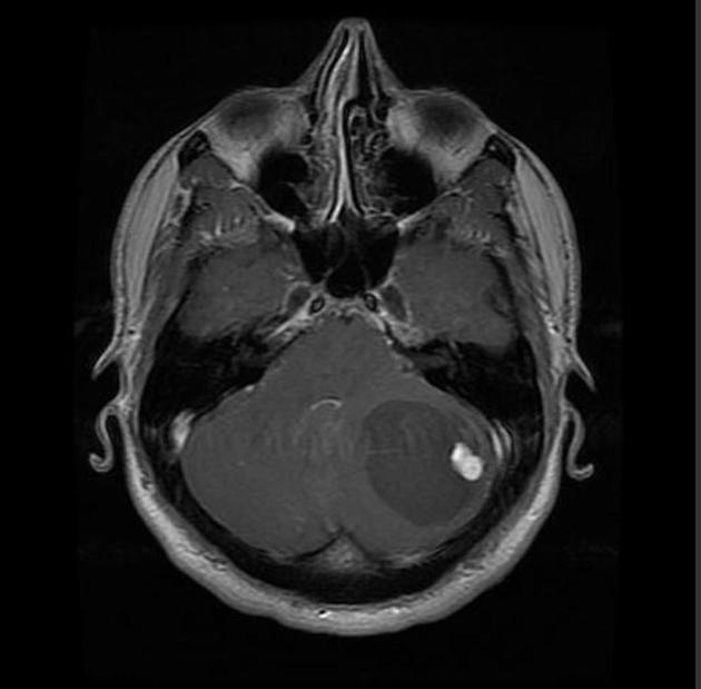Axial post-contrast MRI showing an enhancing cerebellar hemangioblastoma with associated cyst, characteristic of von Hippel-Lindau disease